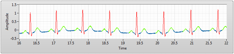 Write ECG 3.png